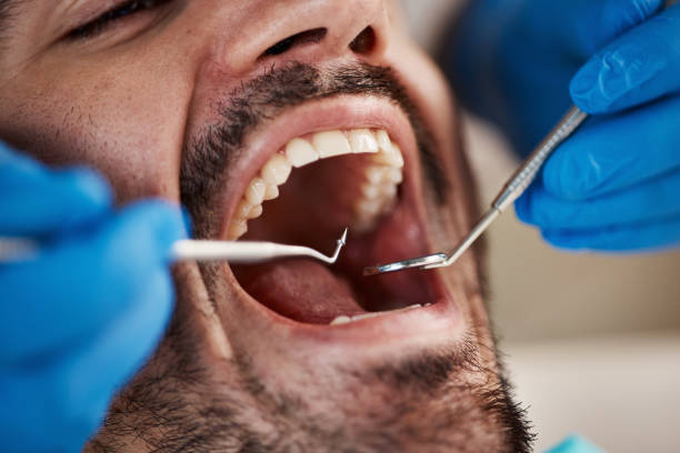 Best Emergency Dentist for Lost Fillings or Crowns in Bayou La Batre, AL